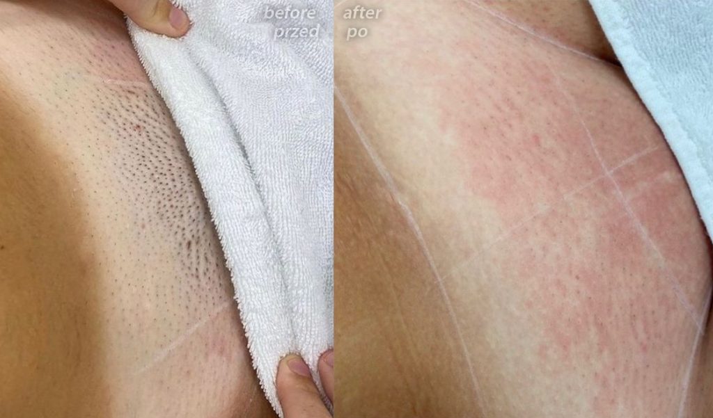 before after laser hair removal gdansk